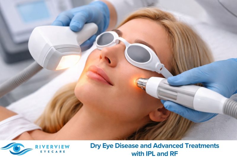 Dry Eye Disease and Advanced Treatments with IPL and RF