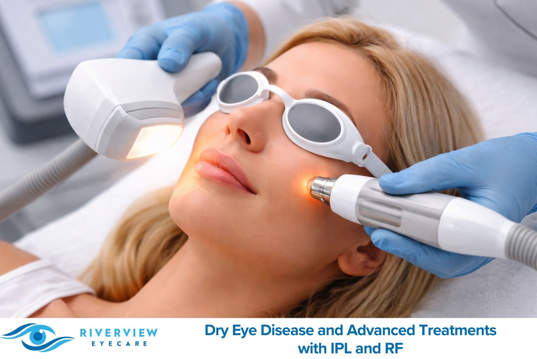 Dry Eye Disease and Advanced Treatments with IPL and RF